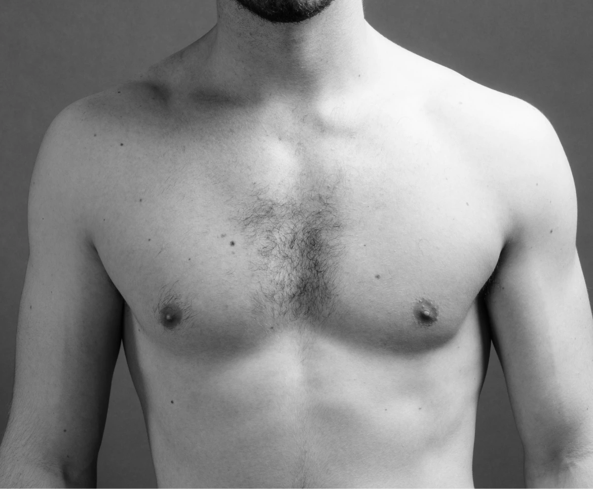 Gynecomastia Treatment in Boston Banner